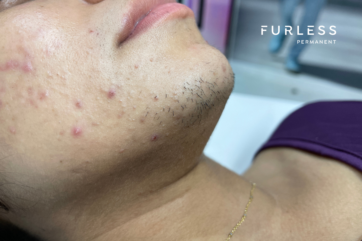 PMOS Female Chin Facial Hair Growth