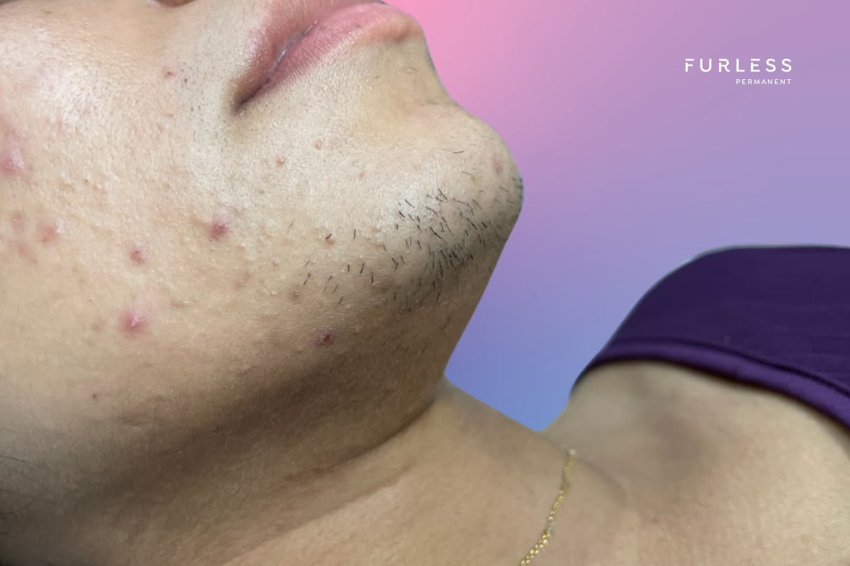 PMOS Female Chin Facial Hair Growth